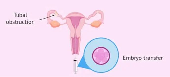 reciprocal ivf