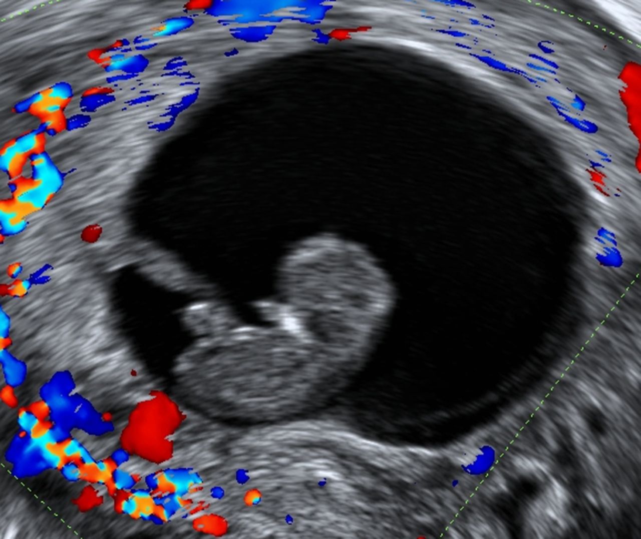 first trimester pregnancy loss miscarriage