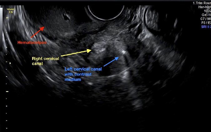 hysterosalpingo contrast sonography