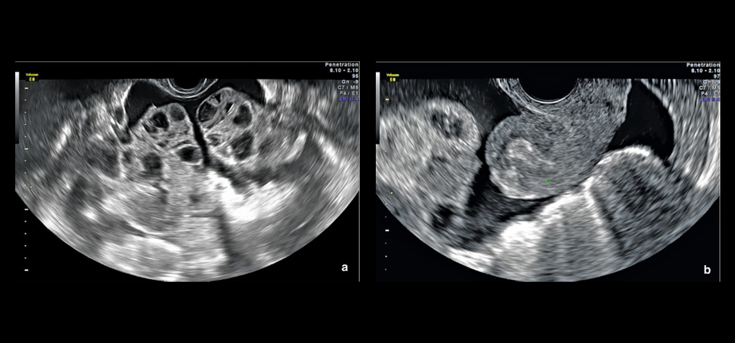 ovarian hyperstimulation syndrome (ohss)