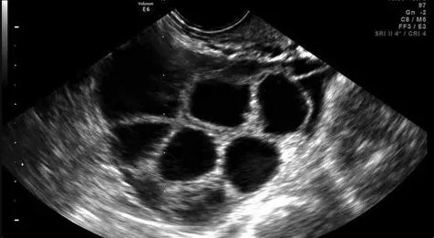 ovarian stimulation and egg collection