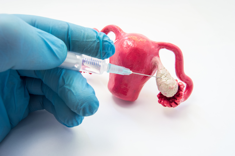 ovulation induction