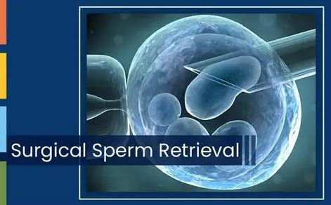 surgical sperm retrieval